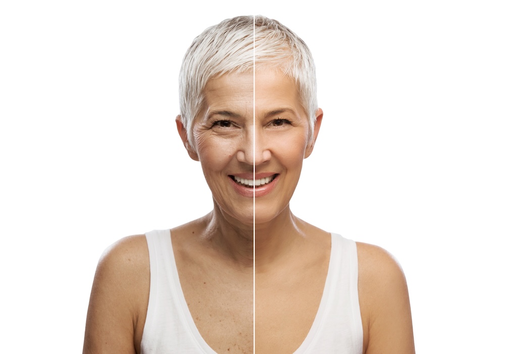 Botox Treatment areas
